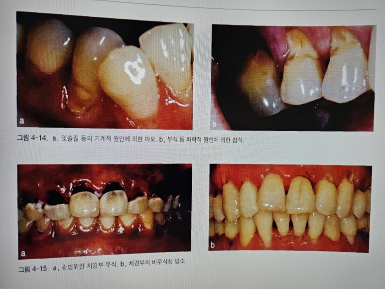 치아 손상 예시(마모, 침식, 우식, 비우식성 병소)