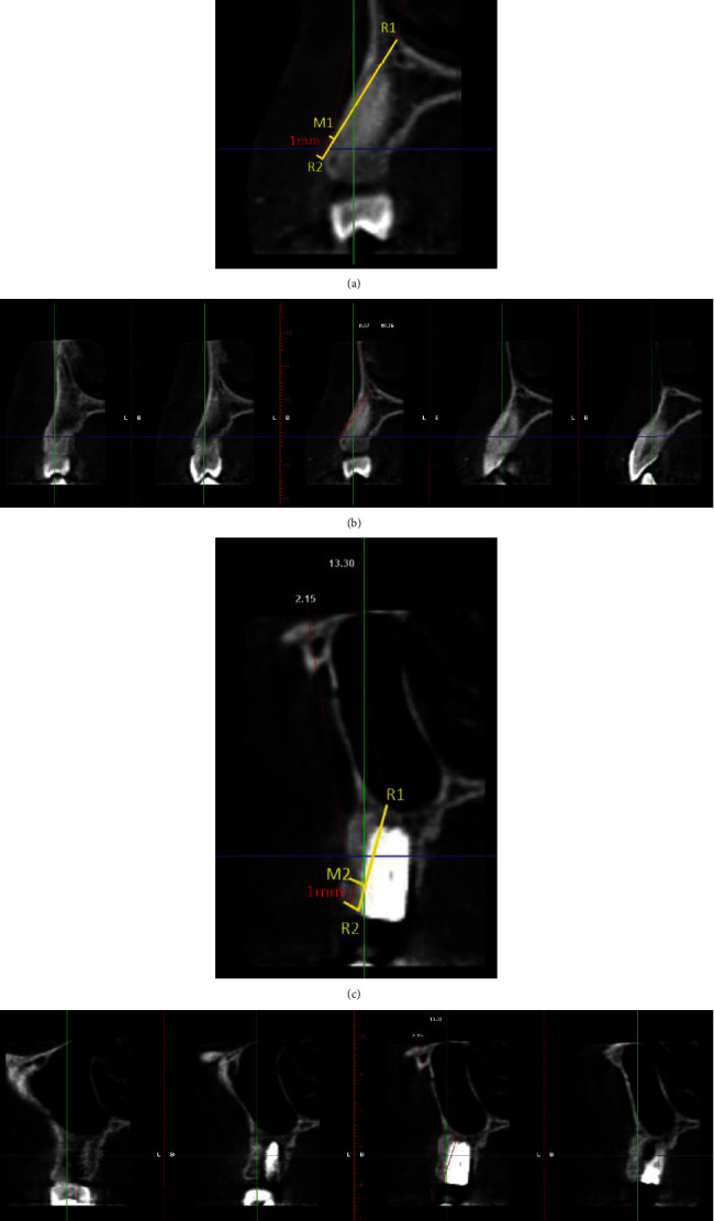 사진 3. 즉시 식립군의 수술 전(a·b)과 수술 후(c·d) CBCT 예시.